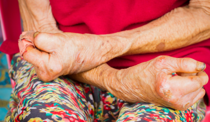 HANSENÍASE: PENSÃO ESPECIAL